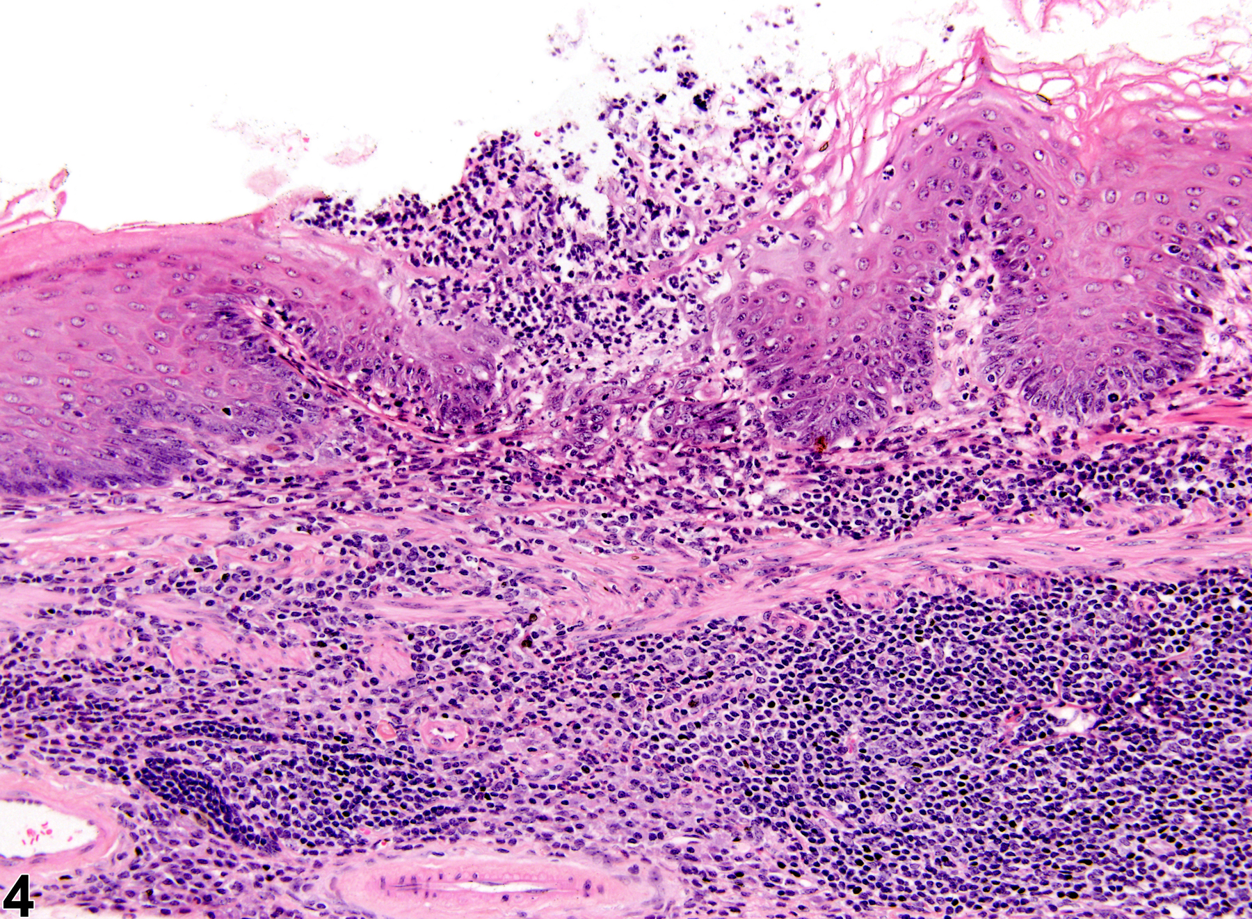 Image of inflammation in the forestomach from a female B6C3F1 mouse in a chronic study