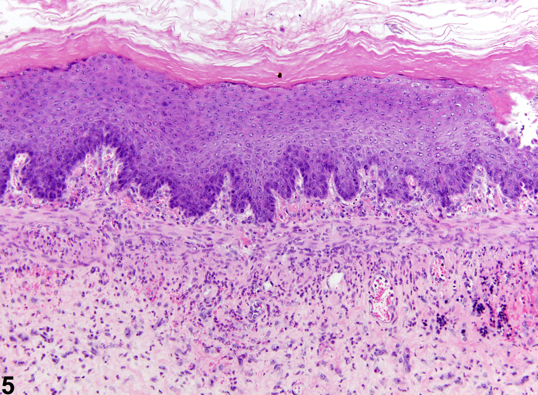 Image of inflammation in the forestomach from a male F344/N rat in a chronic study