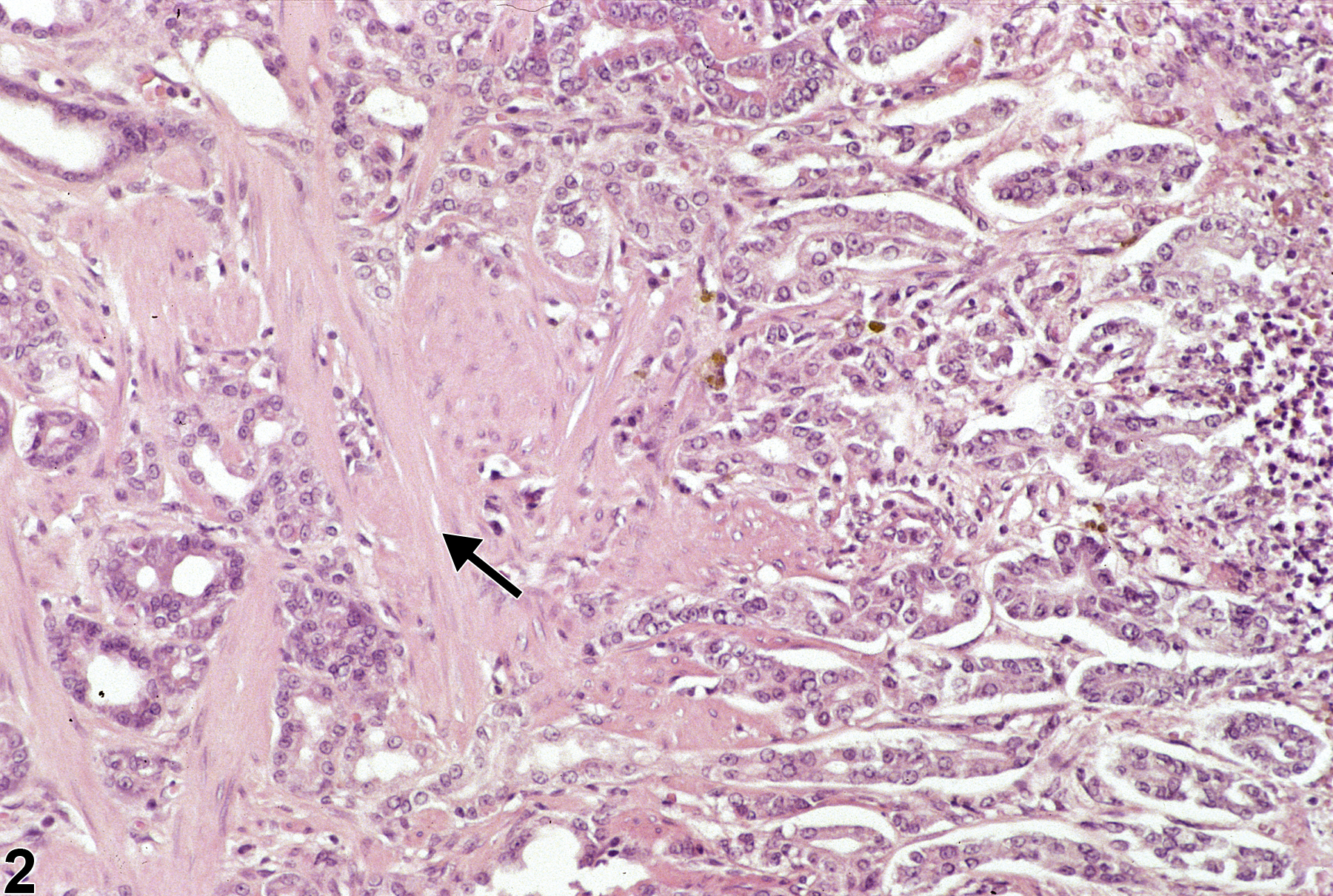 Image of fibrosis in the glandular stomach from a male F344/N rat in a chronic study