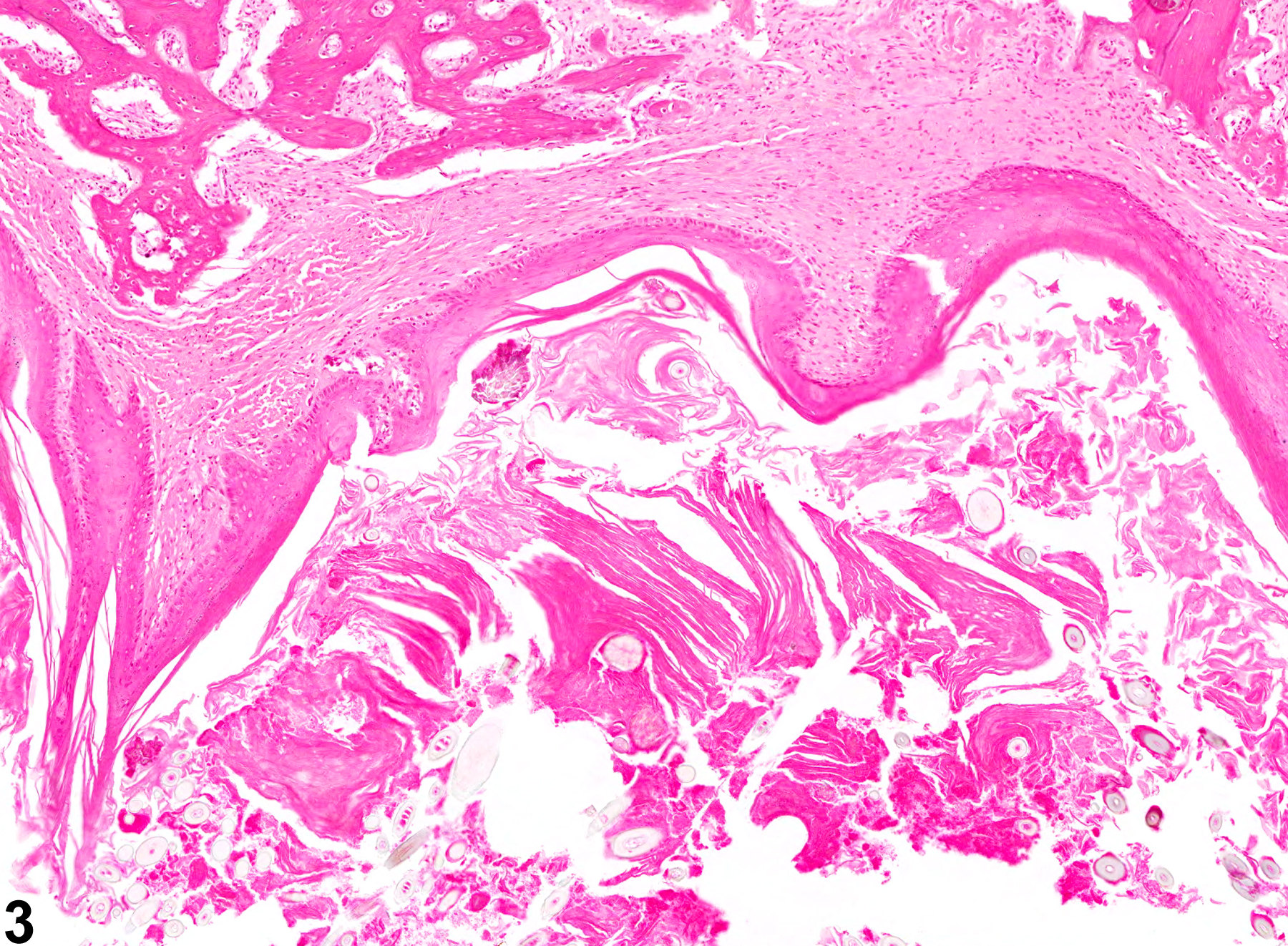 Image of hyperplasia, cystic, keratinizing in the oral mucosa from a male HSD rat in a chronic study