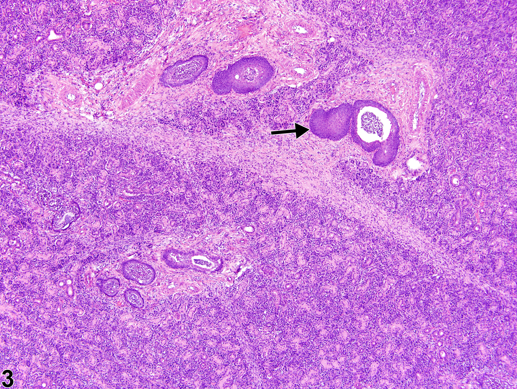 Image of metaplasia, squamous in the salivary gland duct from a male F344/N rat in a chronic study