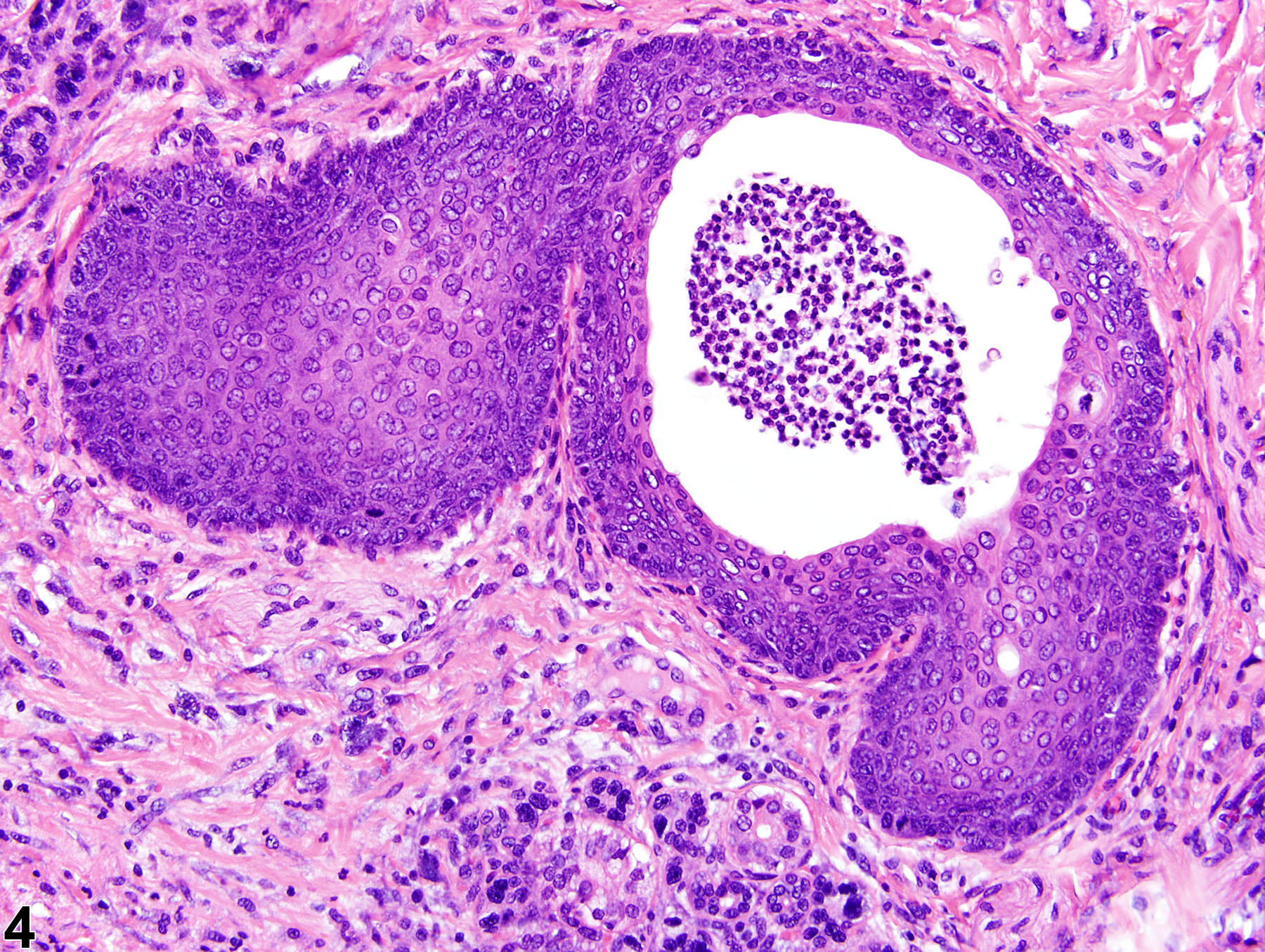 Image of metaplasia, squamous in the salivary gland duct from a male F344/N rat in a chronic study