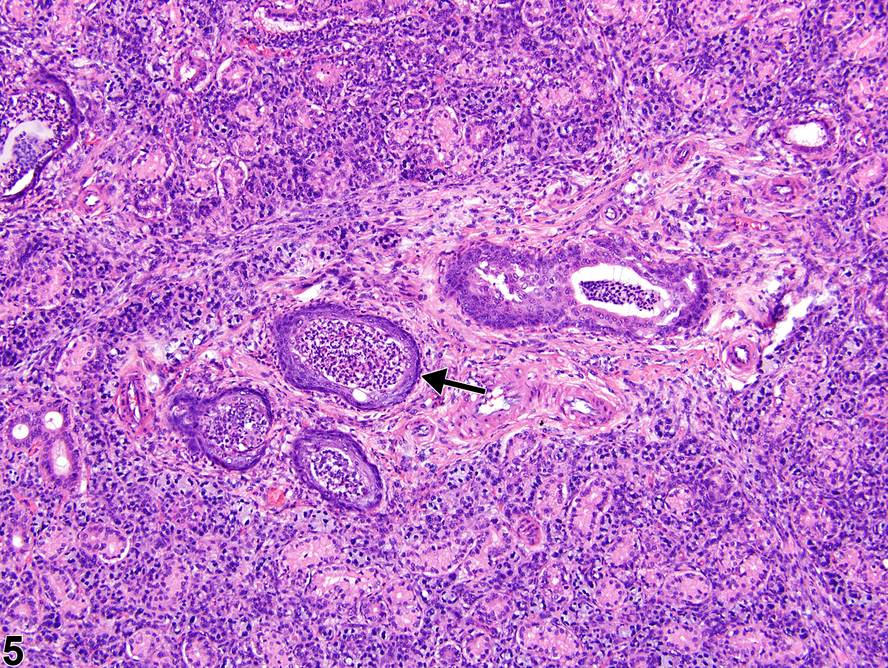 Image of metaplasia, squamous in the salivary gland duct from a male F344/N rat in a chronic study