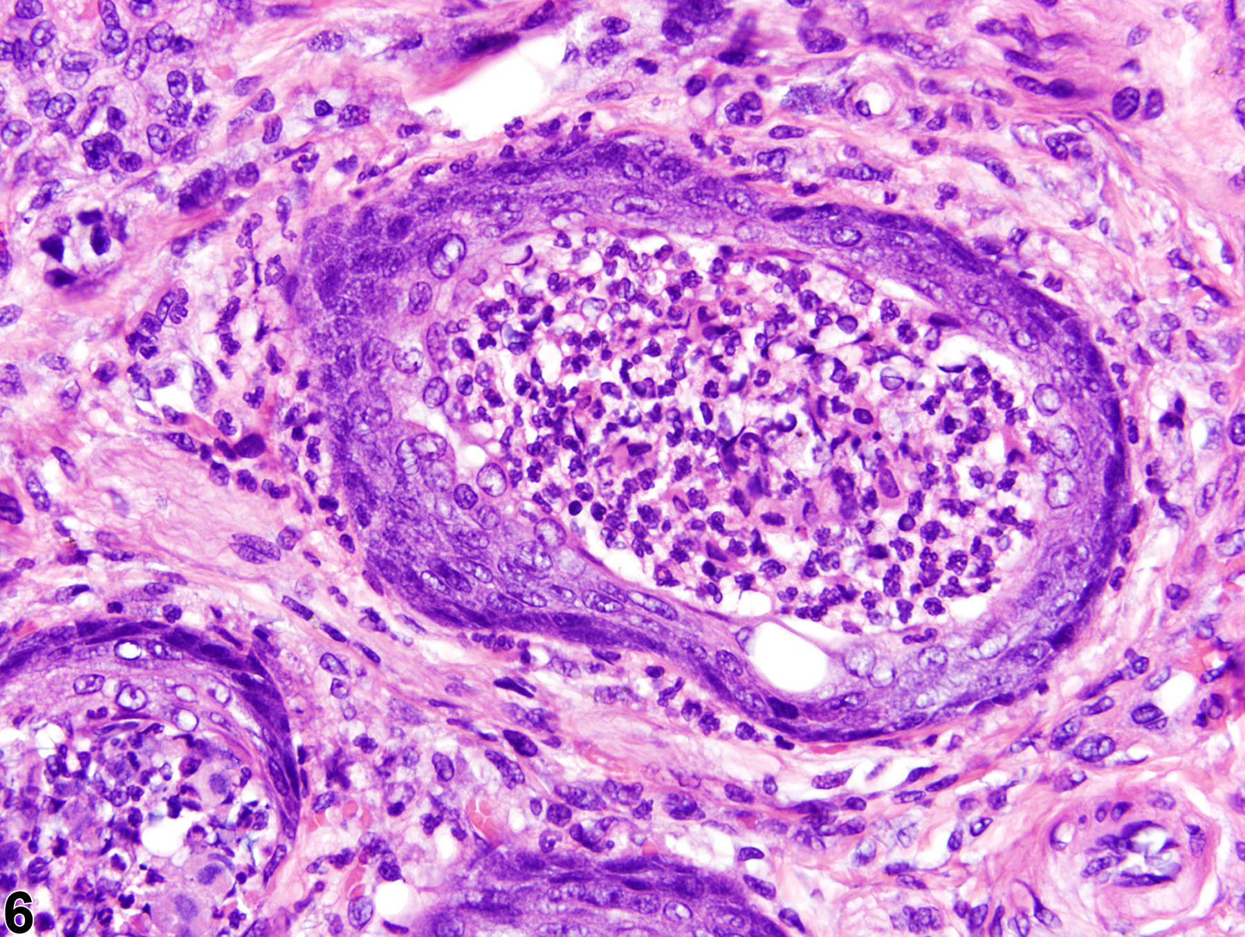 Image of metaplasia, squamous in the salivary gland duct from a male F344/N rat in a chronic study