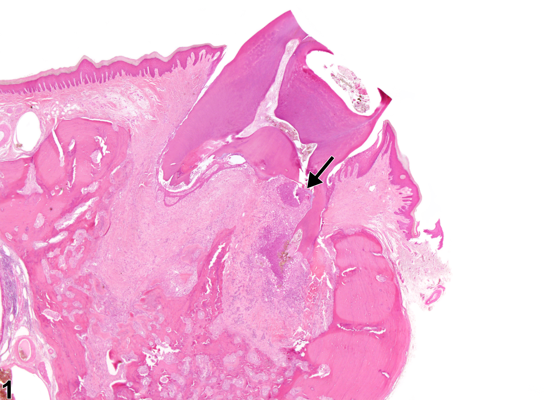 Image of inflammation in the tooth from a male HSD rat in a chronic study