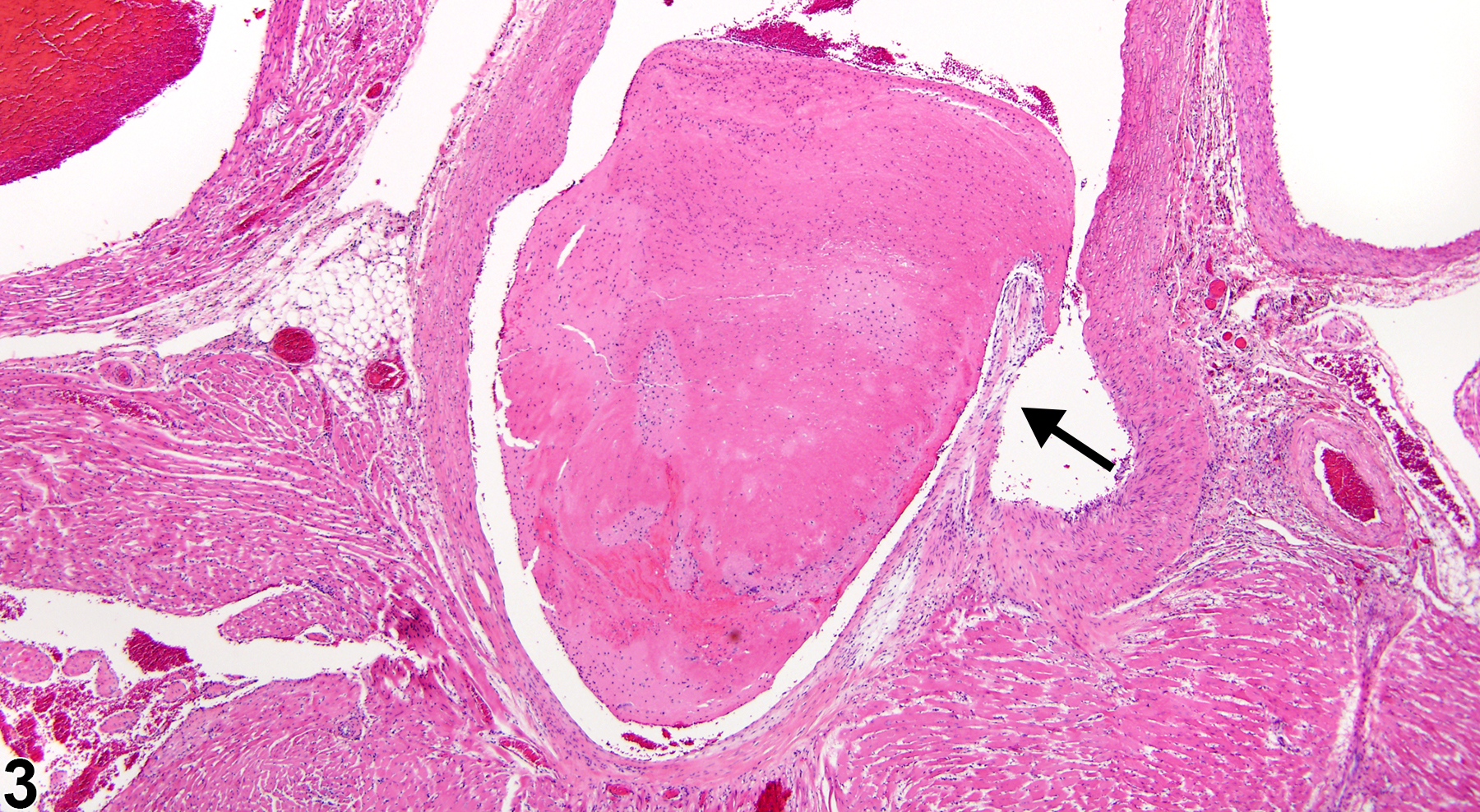 Image of thrombus in the blood vessel from a female F344/N rat in a subchronic study