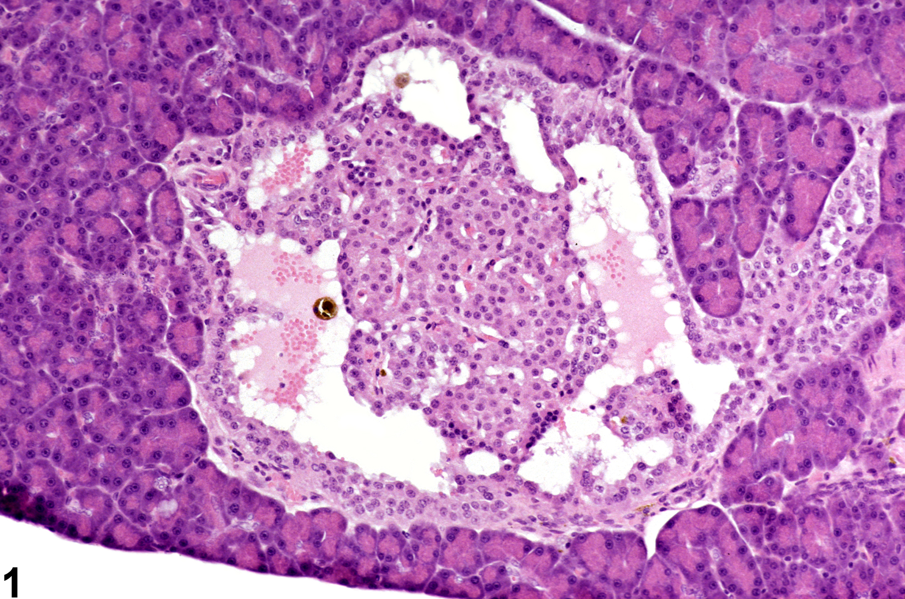 Image of angiectasis in the pancreatic islet from a male F344/N rat in a chronic study