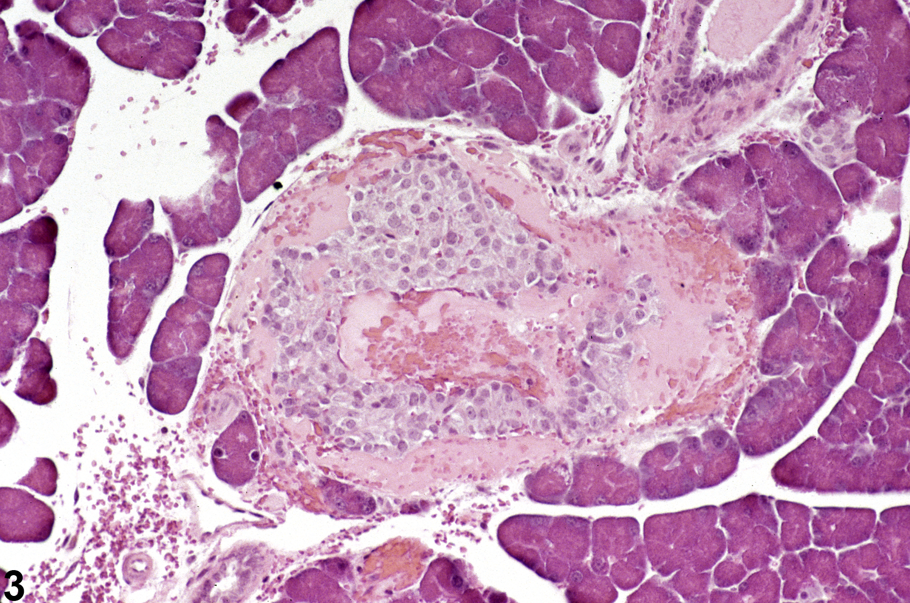 Image of angiectasis in the pancreatic islet from a male B6C3F1 mouse in a chronic study