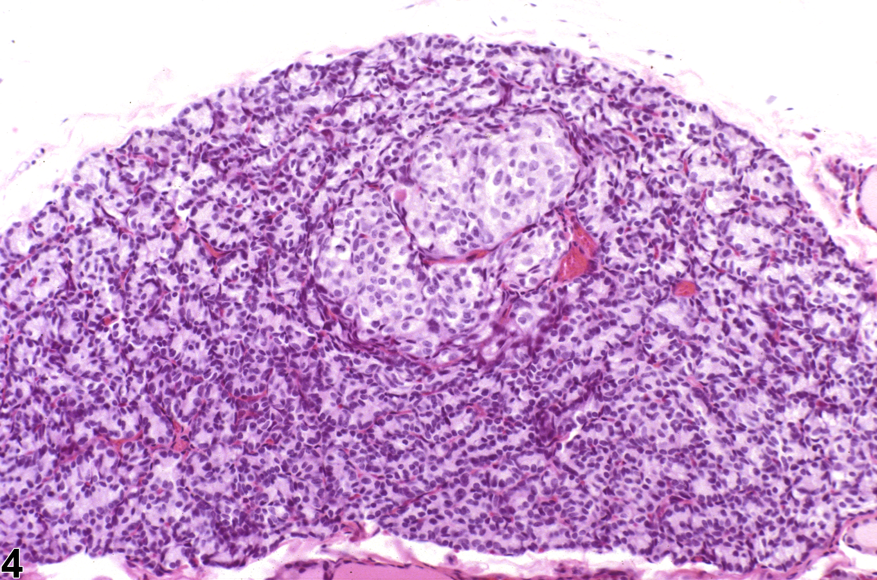 Image of hyperplasia, focal in the parathyroid gland from a male F344/N rat in a chronic study