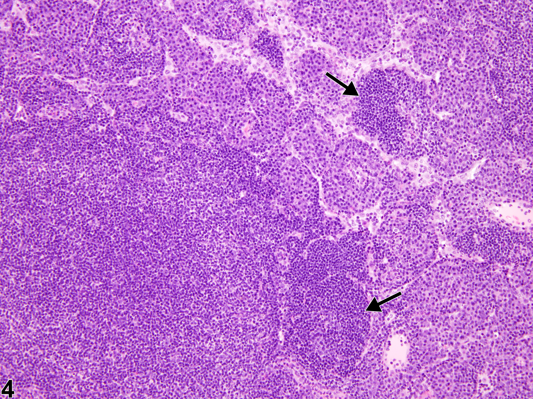 Image of hyperplasia, lymphocyte in the lymph node from a male B6C3F1/N mouse in a subchronic study