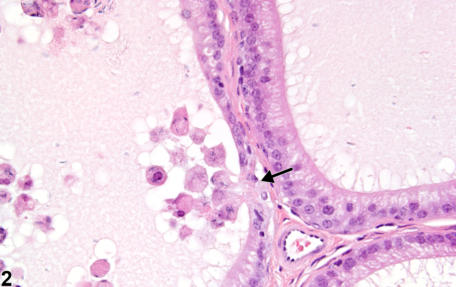 Image of epithelial degeneration in the epididymis from a male B6C3F1 mouse in a chronic study