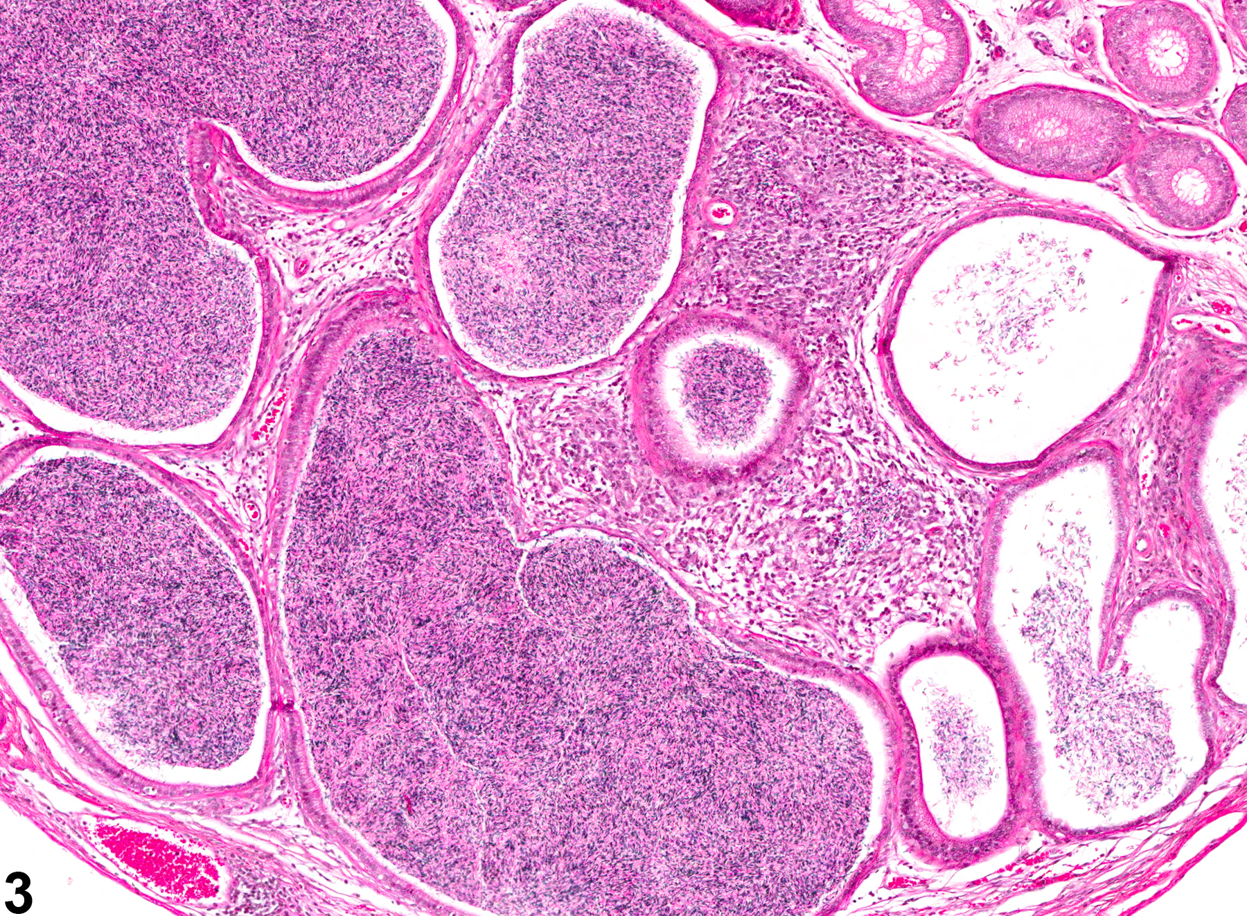 Image of inflammation in the epididymis from a male B6C3F1 mouse in a chronic study