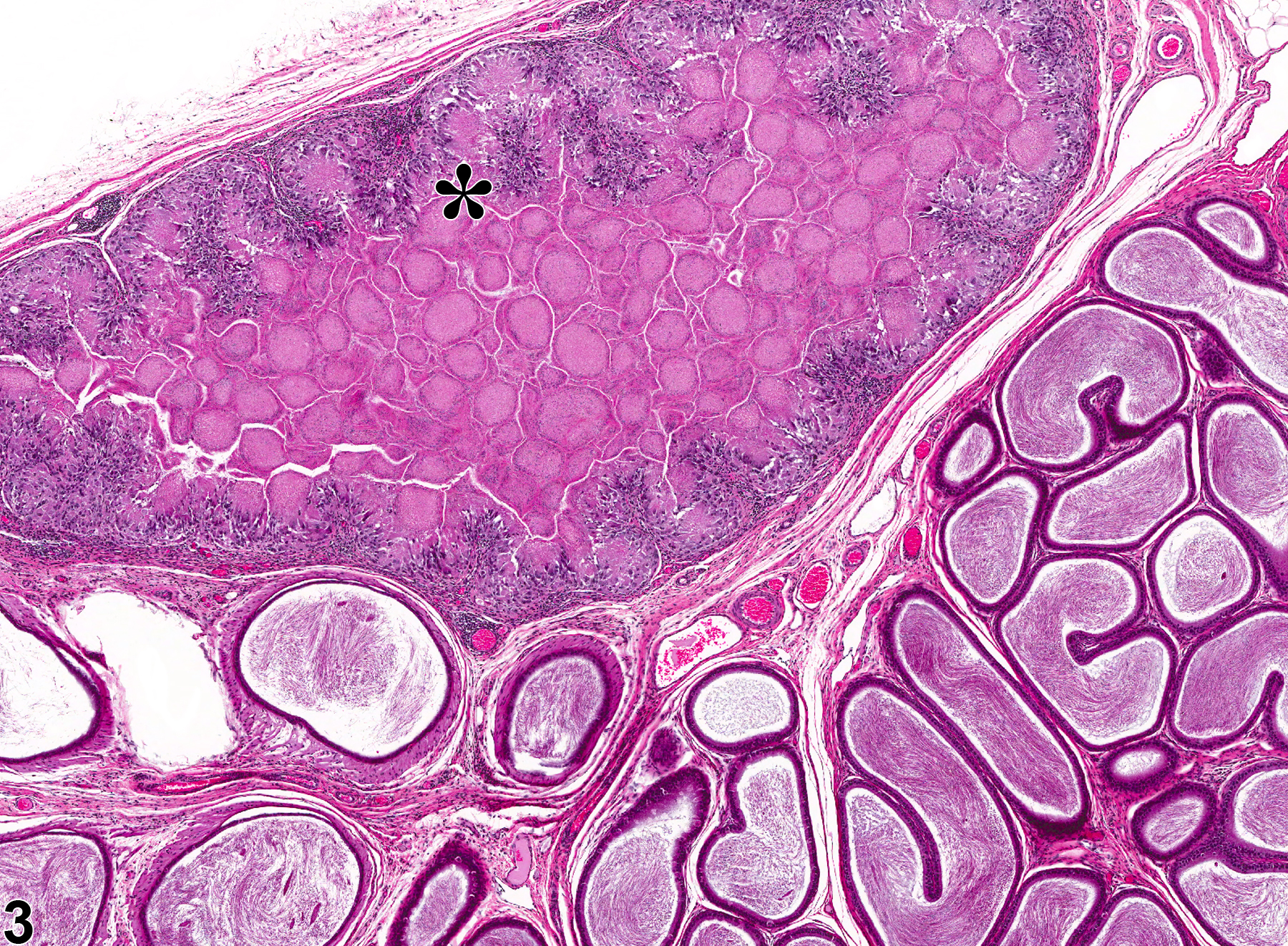 Image of sperm granuloma in the epididymis from a male F344/N rat in a subchronic study