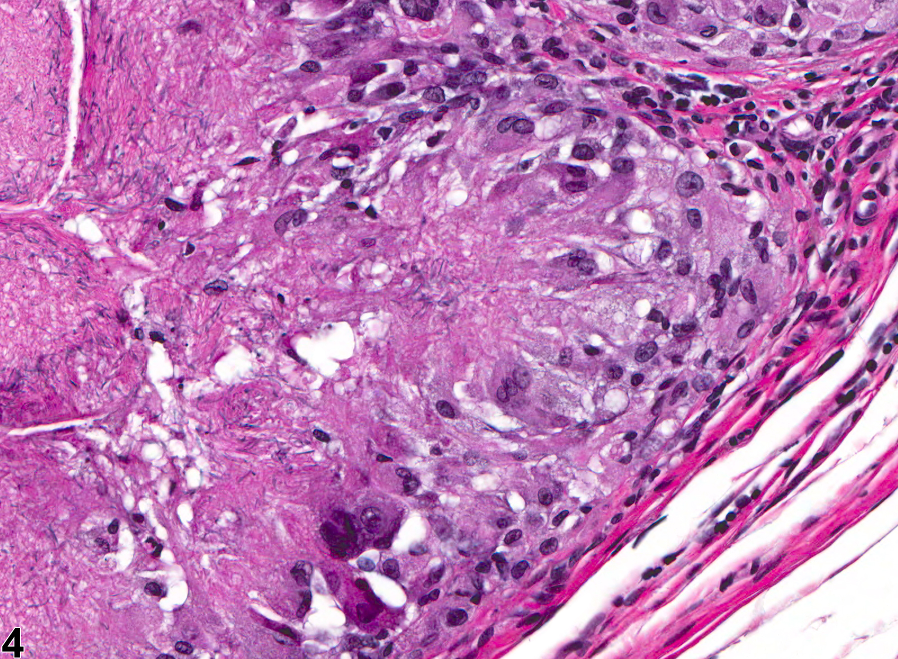 Image of sperm granuloma in the epididymis from a male F344/N rat in a subchronic study