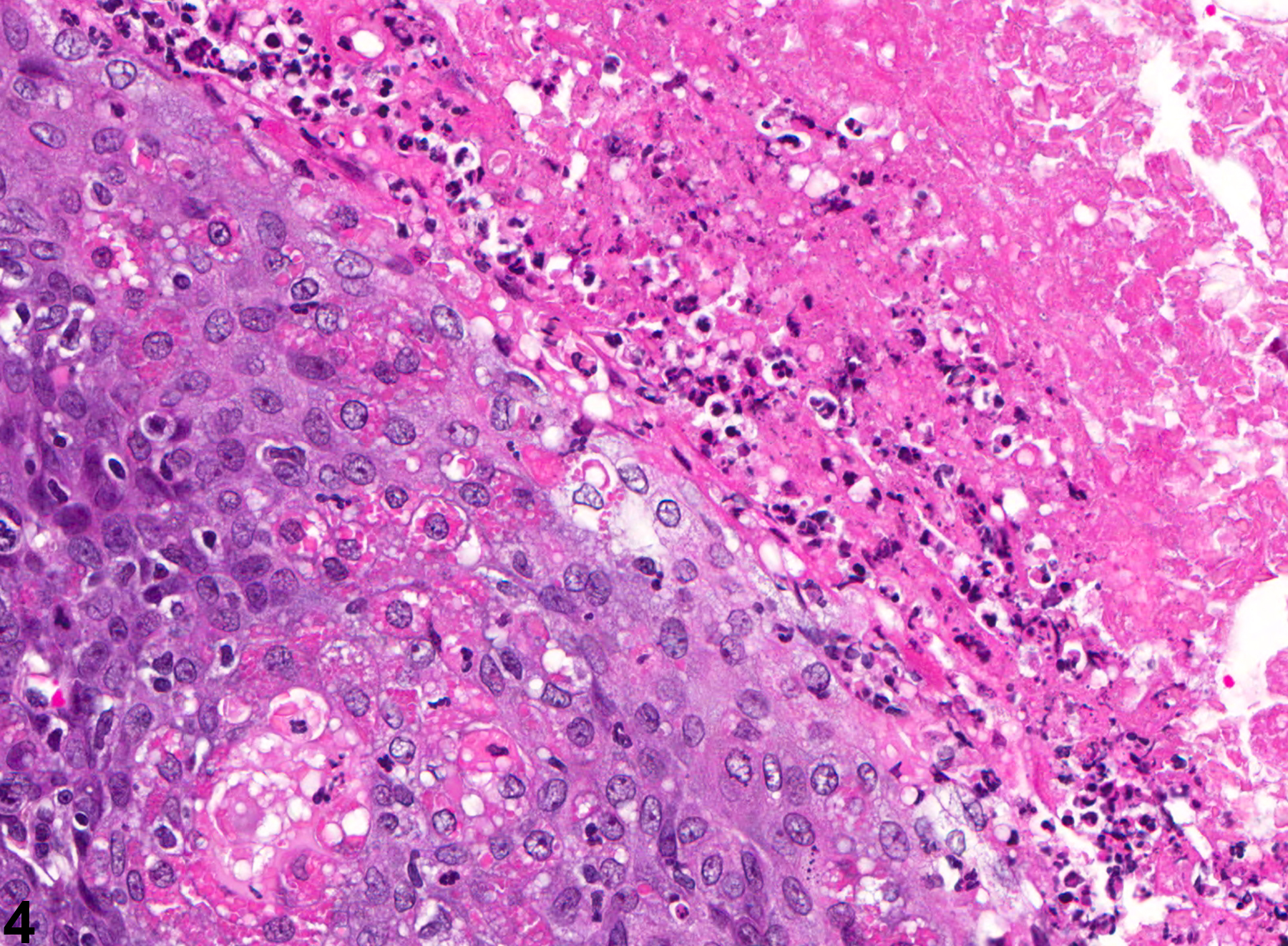 Image of epithelial hyperplasia in the preputial gland from a male F344/N rat in a chronic study