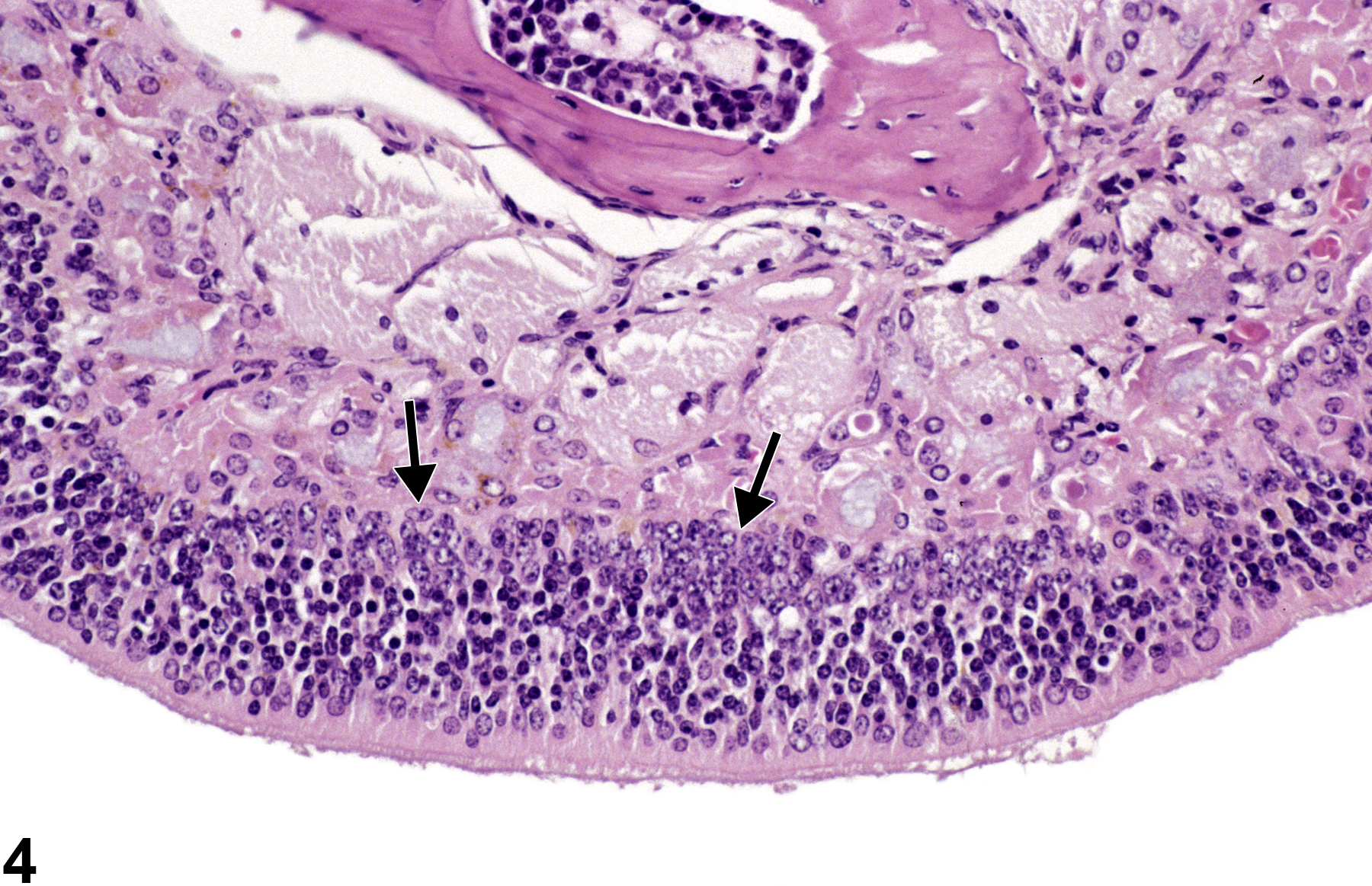 Image of hyperplasia, basal cell in the nose, olfactory epithelium from a male B6C3F1/N mouse in a chronic study