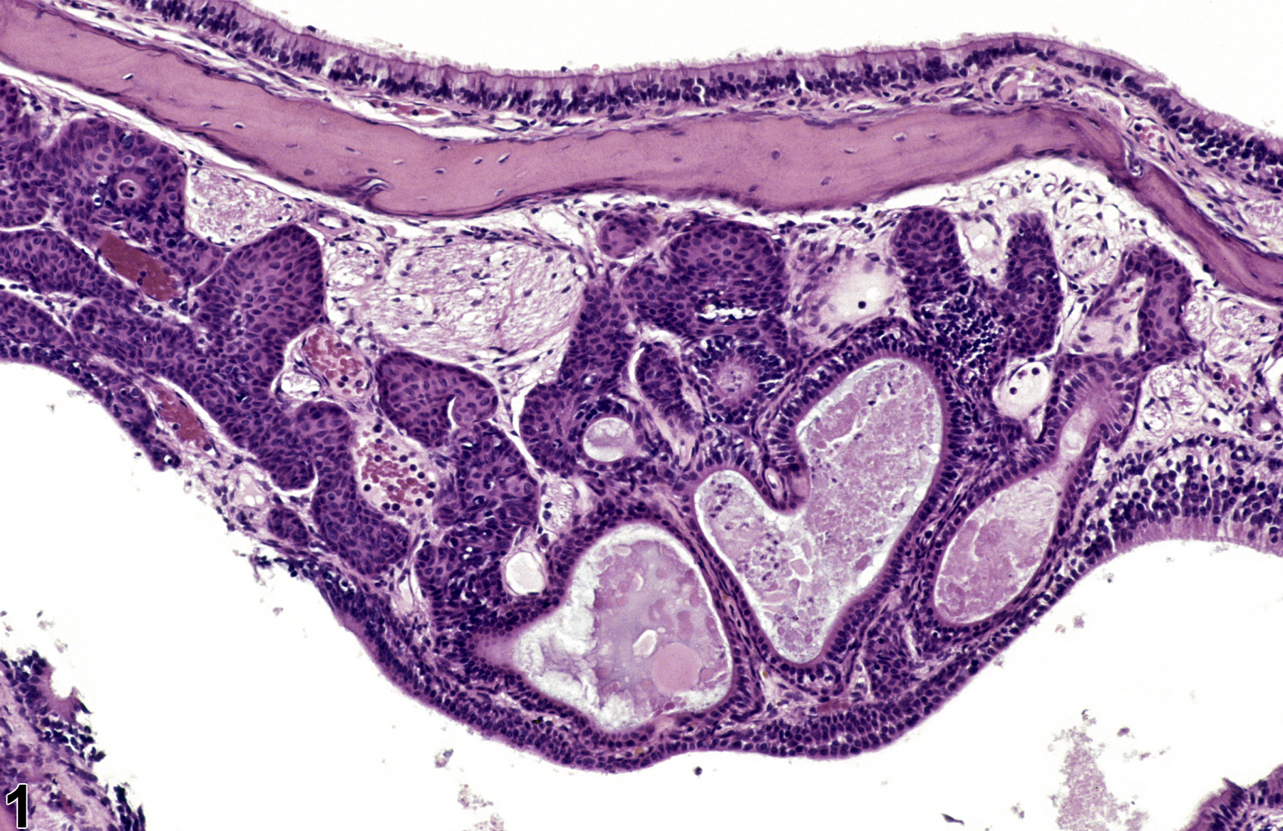 Image of metaplasia, squamous in the nose, olfactory epithelium, glands from a male F344/N rat in a chronic study