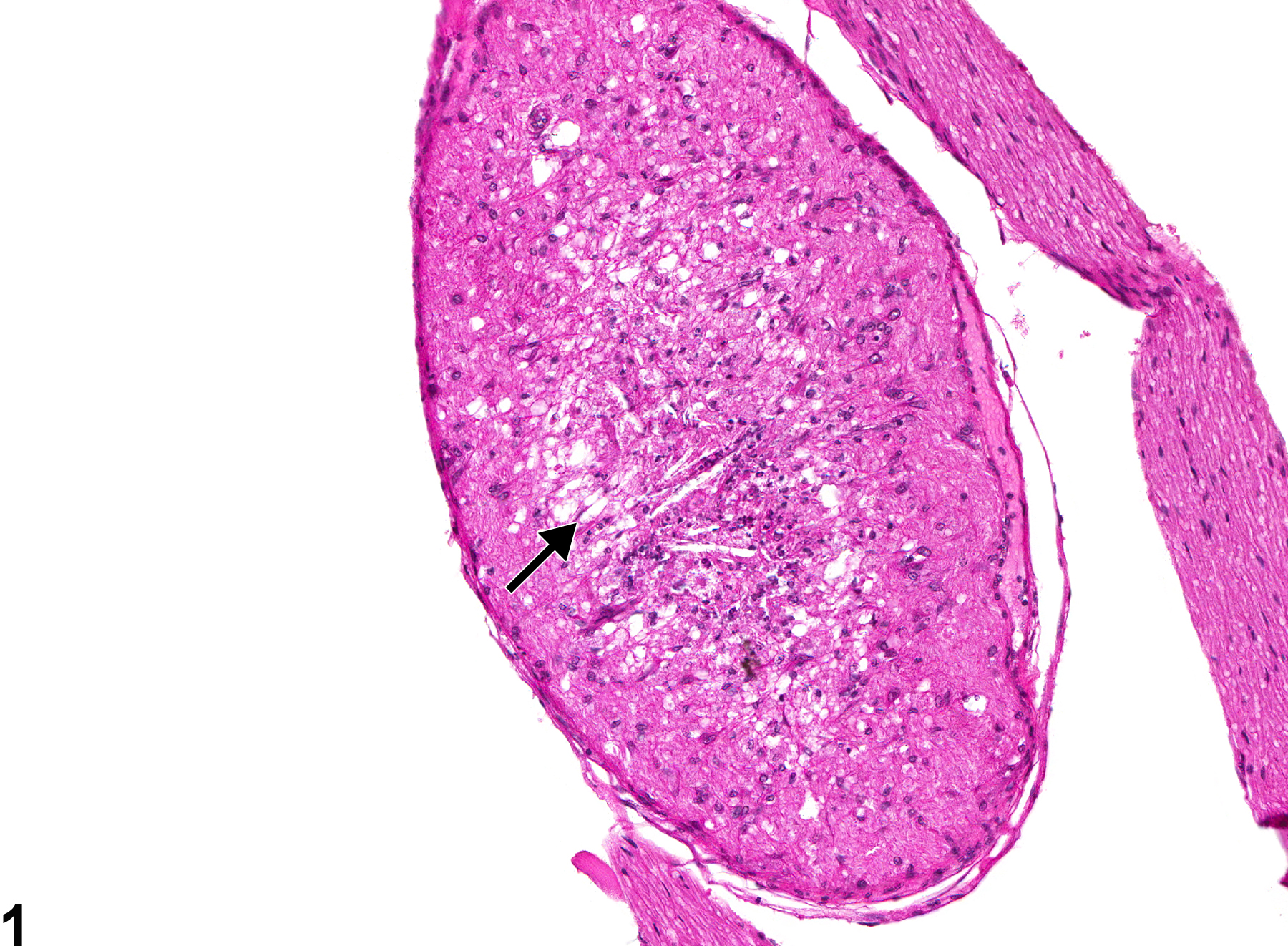 Image of optic nerve degeneration in the eye from a female B6C3F1 mouse in a chronic study