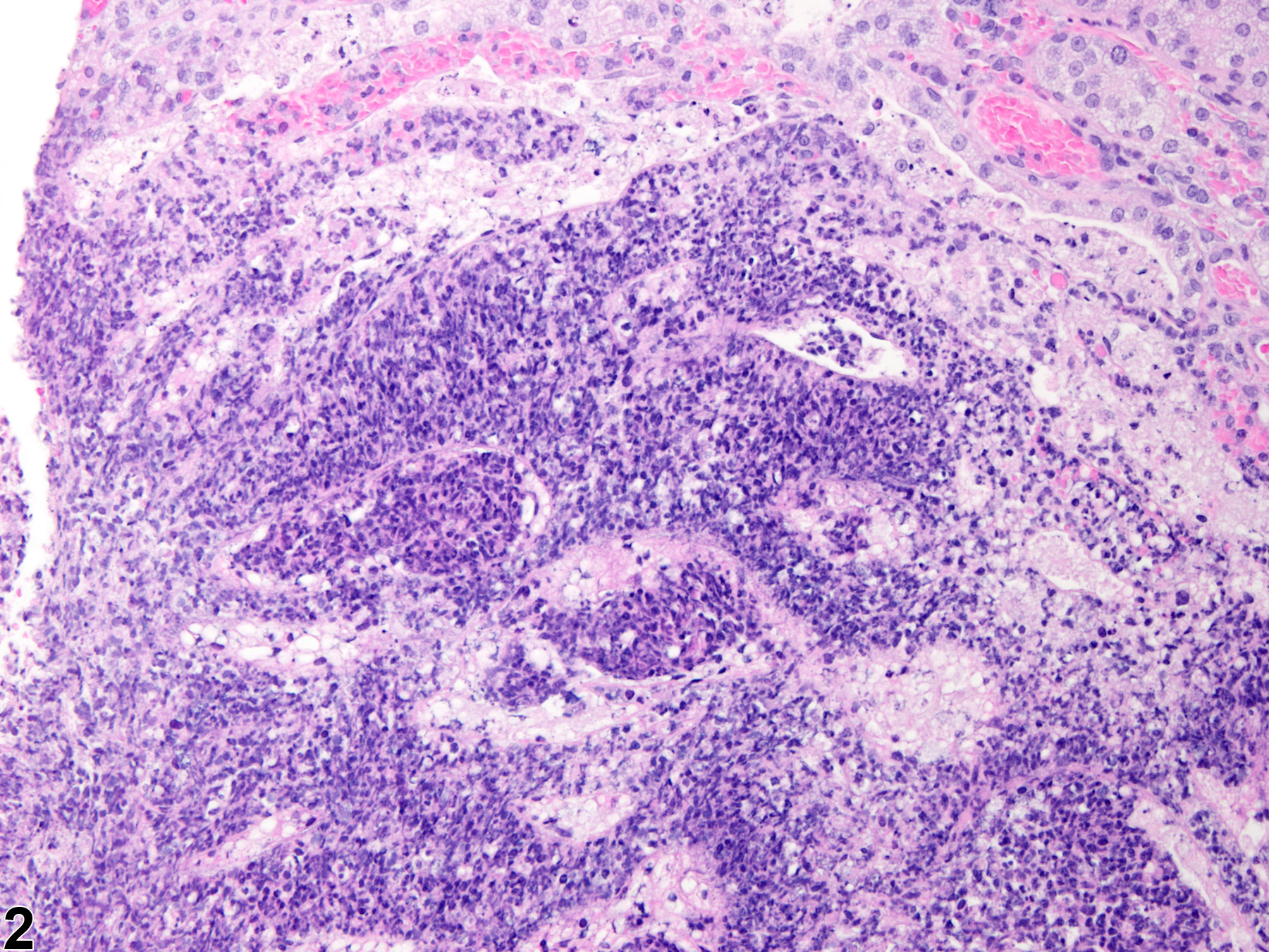 Image of inflammation in the Harderian gland from a female Harlan Sprague Dawley rat in a chronic study