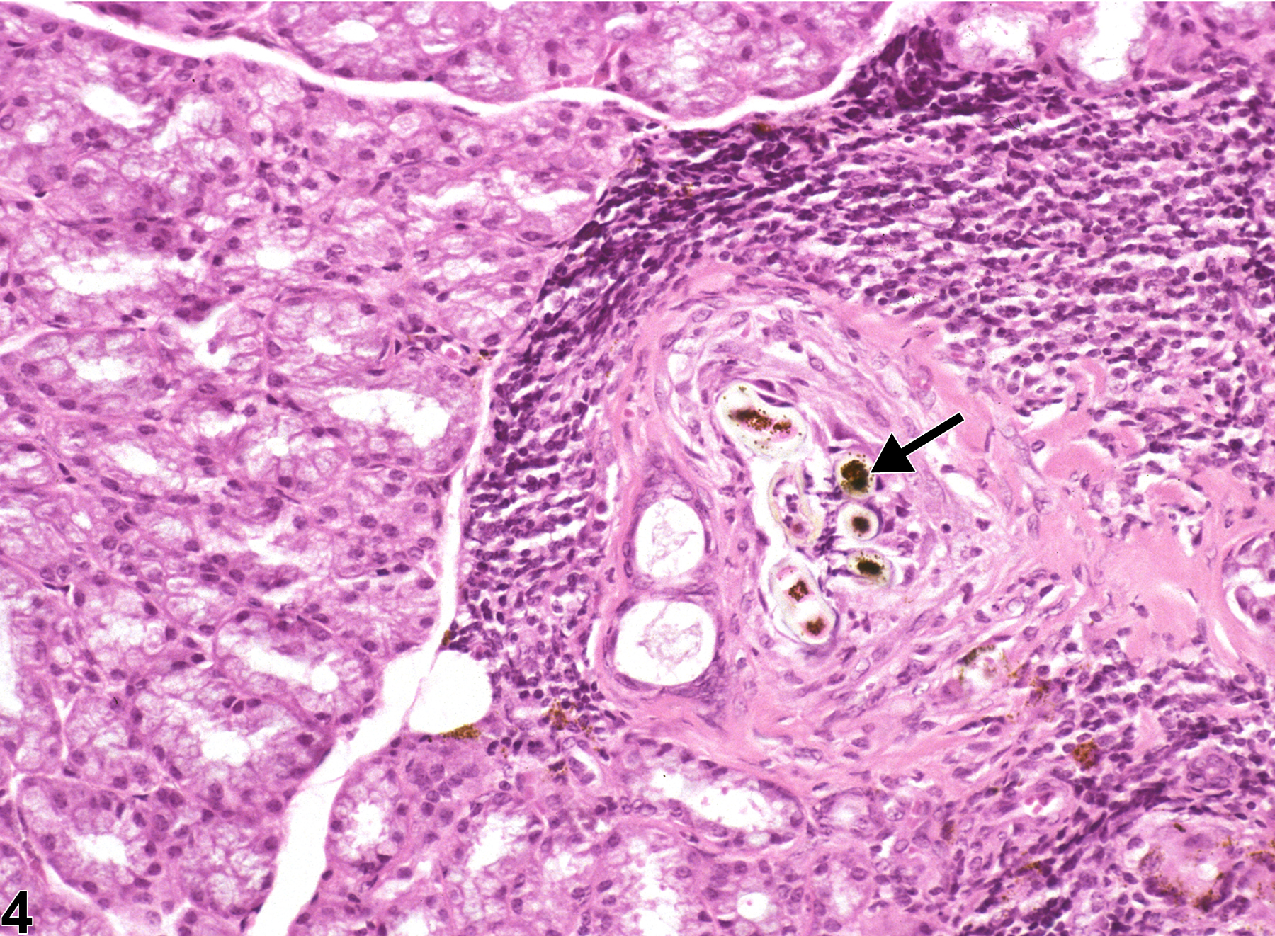 Image of inflammation in the Harderian gland from a female B6C3F1 mouse in a chronic study